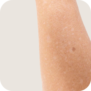 Skin Spots