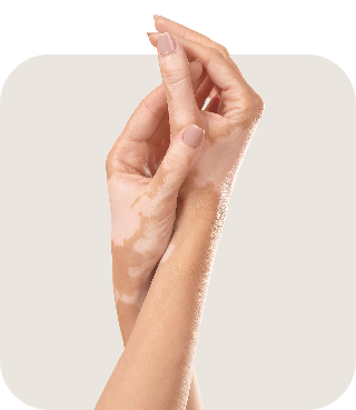 Vitiligo