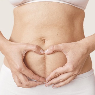 Stretch Marks
