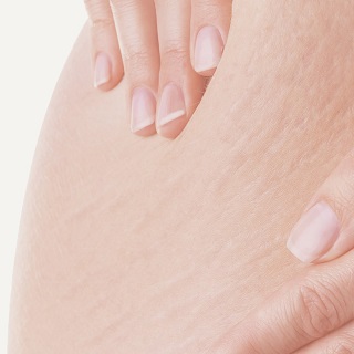 Stretch Marks