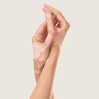 Vitiligo